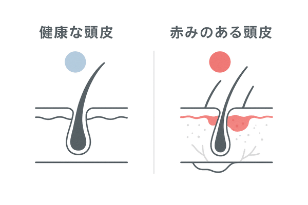 頭皮の赤みと健康な頭皮の違い｜色・弾力・感受性の比較イラスト（抜け毛対策）