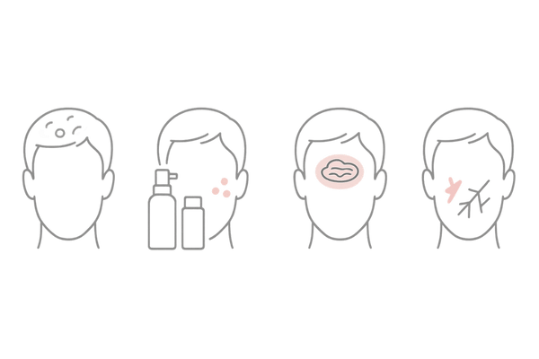 頭皮が赤くなる代表的皮膚疾患｜脂漏性皮膚炎・接触皮膚炎・頭皮乾癬・アトピーの症状アイコン