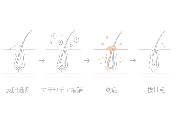 脂漏性皮膚炎のメカニズム｜皮脂過多→マラセチア増殖→炎症→抜け毛の流れ