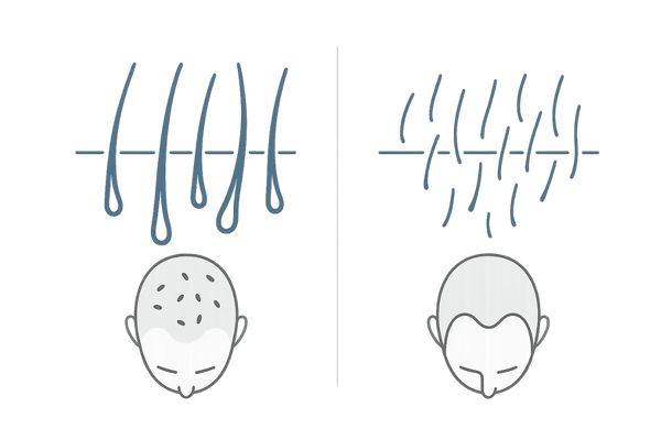 季節性の抜け毛とAGAの違い｜毛の質・抜け方・進行パターンの比較イメージ