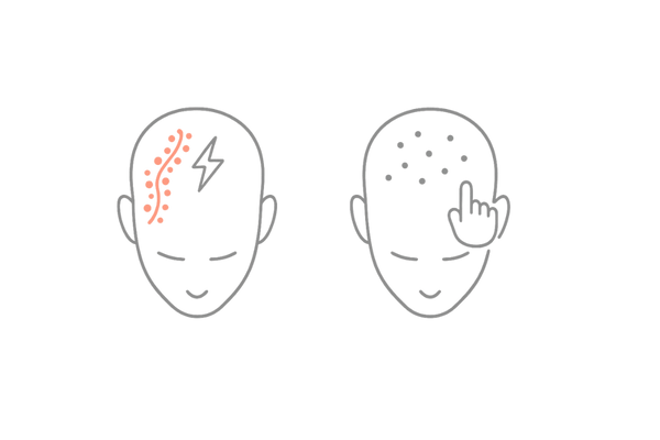 頭皮の帯状疱疹と毛嚢炎の違い（分布と痛みの特徴の比較図）