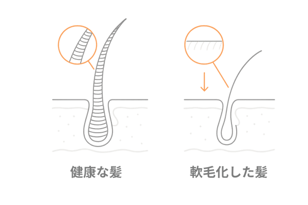 軟毛化と健康な髪の比較イラスト（太さ・ハリの違いが一目で分かる）