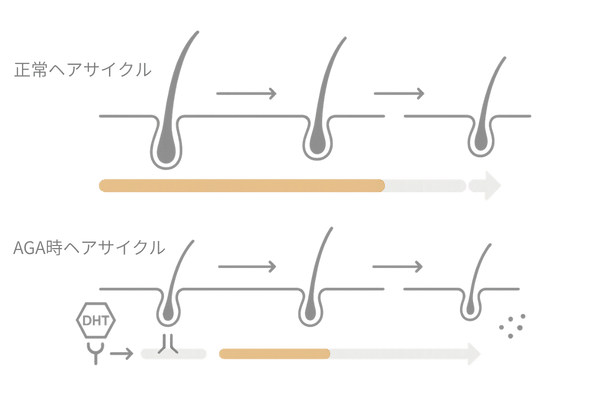 AGAによるヘアサイクル短縮のメカニズム図（成長期の短縮を可視化）