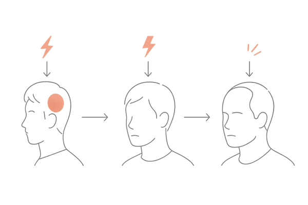 ストレスの種類と脱毛タイプの関係｜急性ストレス・慢性ストレス・AGAの比較