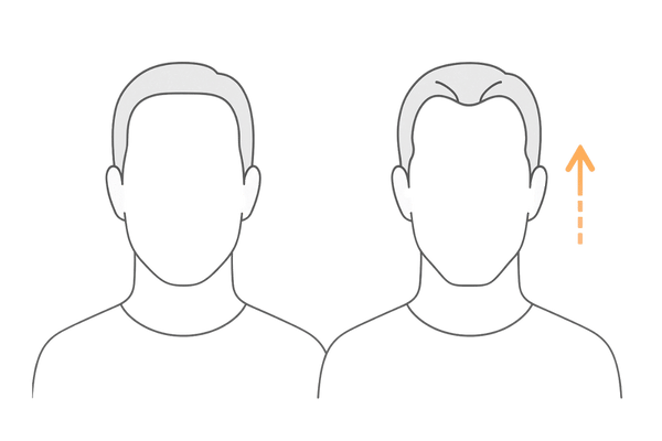 こめかみの薄毛が目立つ理由|顔のフレームと生え際後退の見え方