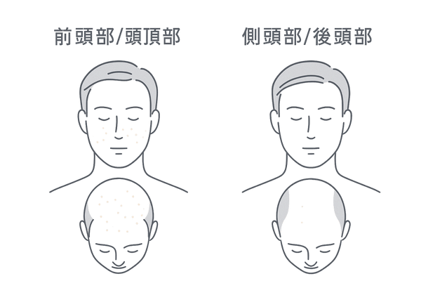 AGAと側頭部の関係：部位別リスクの違い（前頭部・頭頂部と側頭部・後頭部の比較図）
