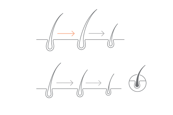 ヘアサイクルの乱れと軟毛化：正常と短縮の比較図（AGA/びまん性脱毛を示唆）
