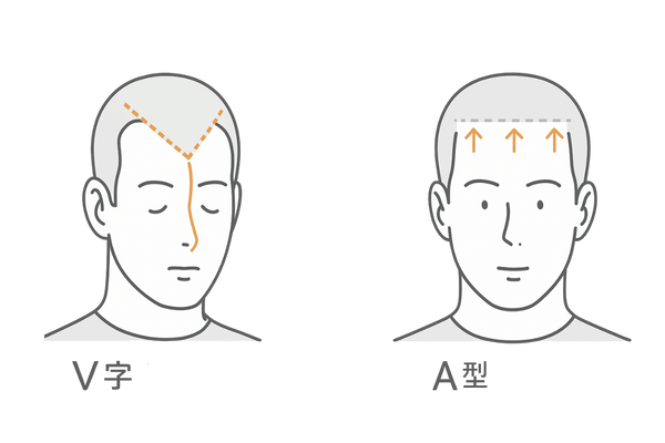 V字型（M字）とアルファ型（A型）生え際の脱毛パターン比較イラスト｜額両サイド後退と生え際全体後退の違い