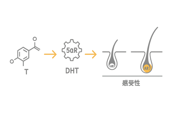 テストステロン→DHTと遺伝的感受性｜AGAメカニズムの流れ図