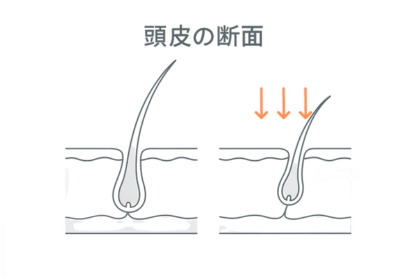 DHTによる毛包ミニチュア化を示す頭皮断面図（育毛剤では止めにくい理由の可視化）
