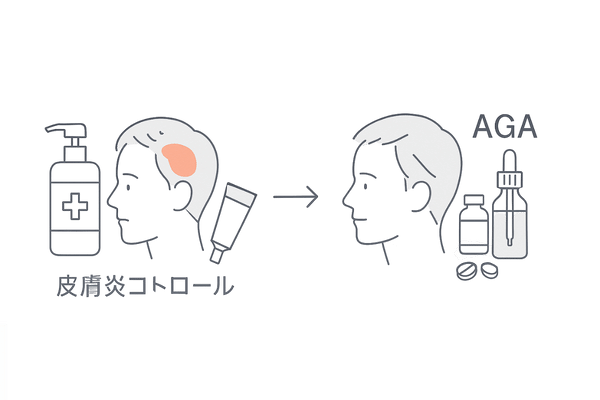 併発時の治療ステップ図｜まず皮膚炎を鎮めてからAGA治療へ