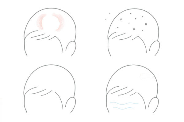 危険な頭皮サインの見分け方｜赤み・フケ・弾力低下と健康頭皮の比較