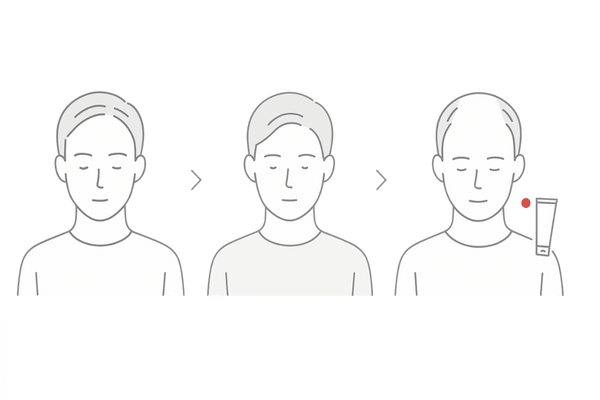 中期サインの見極め図｜分け目拡大・つむじ周囲の薄さ・スタイリングで隠せない状態
