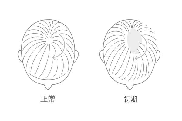 正常なつむじと初期つむじハゲの比較｜地肌の見え方と髪密度の違い