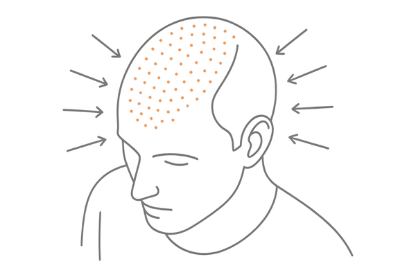 前髪とつむじが同時に薄くなる理由｜DHT受容体分布イメージ