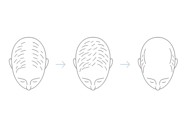 O字とM字の同時進行からU字へ｜連結の進行イメージ（時系列3コマ）