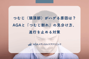 つむじ(頭頂部)がハゲる原因は?AGAと「つむじ割れ」の見分け方、進行を止める対策