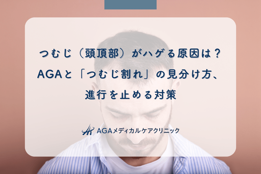 つむじ（頭頂部）がハゲる原因は？AGAと「つむじ割れ」の見分け方、進行を止める対策