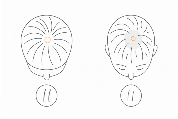 正常なつむじと初期つむじハゲの違い｜髪の細さ・密度・地肌の見え方を比較