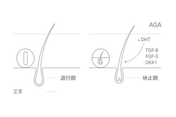 ヘアサイクルの比較：正常 vs AGA（成長期短縮と軟毛化の流れ）