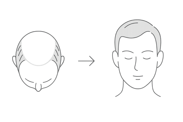 頭頂部・生え際の見た目改善(服用6ヶ月〜1年)の部位別イメージ