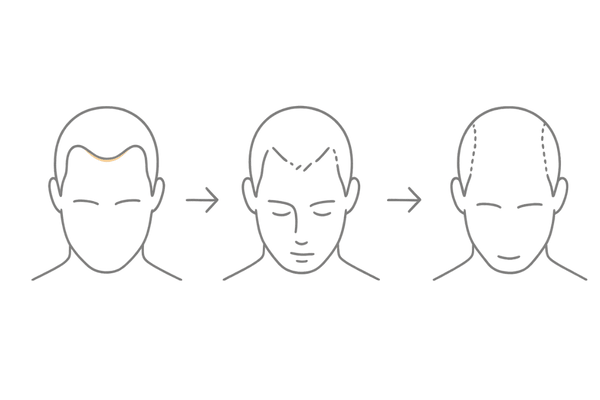 おでこのハゲの初期サイン図解｜M字・生え際の変化がわかる3ステップ