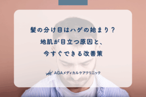 髪の分け目はハゲの始まり？地肌が目立つ原因と、今すぐできる改善策