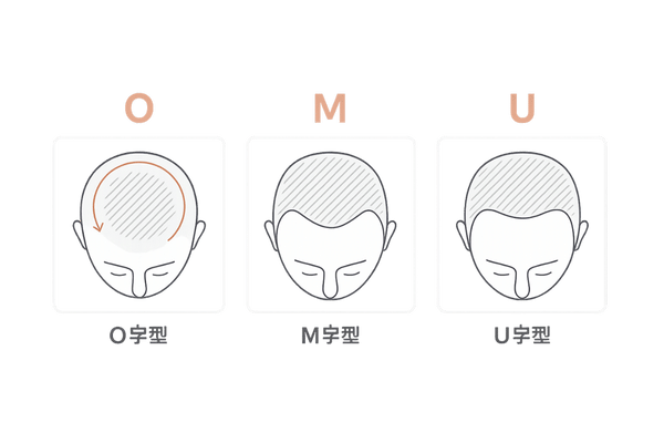 カッパはげのO字型と他の薄毛パターン（M字・U字）の形状比較イラスト｜頭頂部から広がる進行像