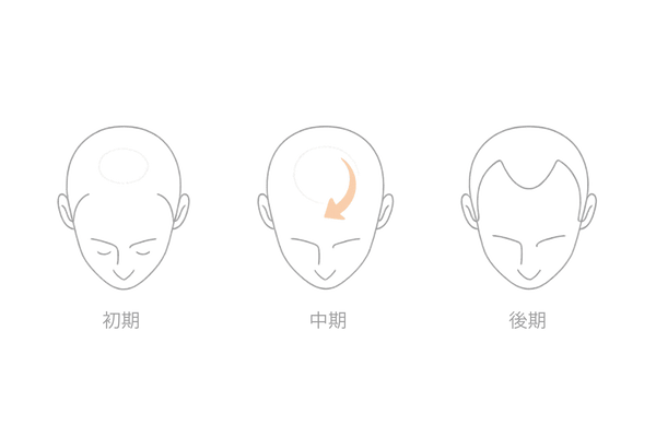カッパはげ（頭頂部O字）の進行ステップ（初期→中期→後期）と範囲拡大のイメージ