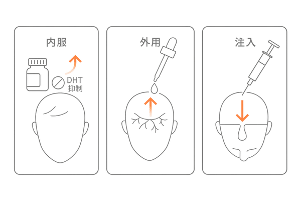 AGA治療の役割分担：内服（守り）× 外用（攻め）× 注入（直接アプローチ）の概念図