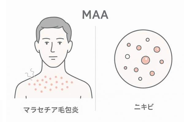 マラセチア毛包炎とニキビの違い｜芯の有無・発疹の均一性・かゆみの比較