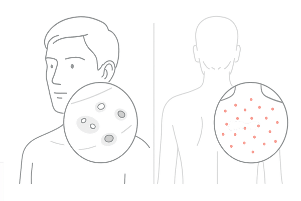 マラセチア毛包炎とニキビの違い|均一な丘疹と面皰の有無を比較