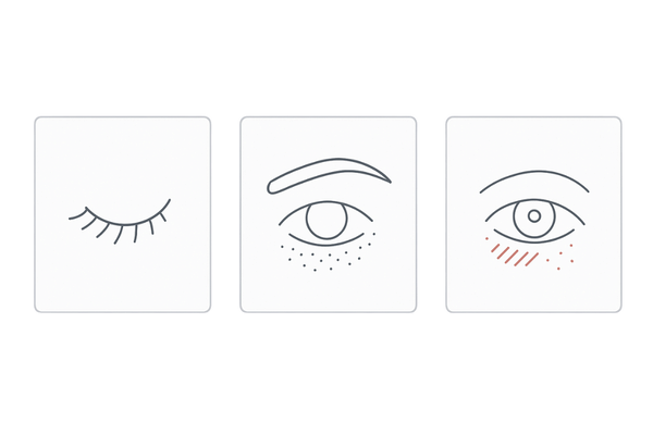 まつげの不均衡と目元産毛の増加・皮膚トラブルの例