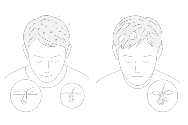 乾性フケと脂性フケの違いを比較した頭皮イラスト