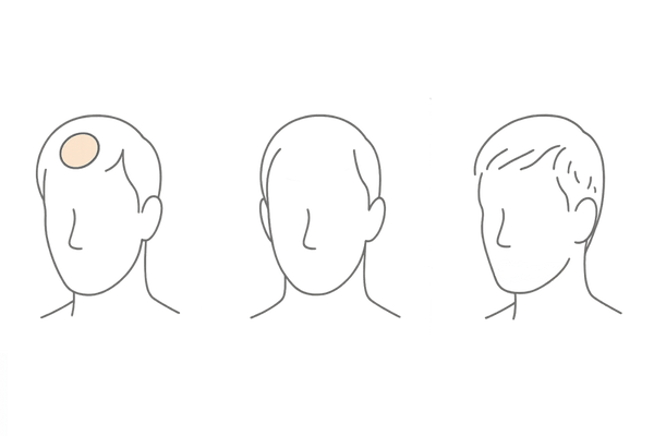 円形脱毛症・休止期脱毛症・抜毛症の違いを示す3カラム線画アイコン