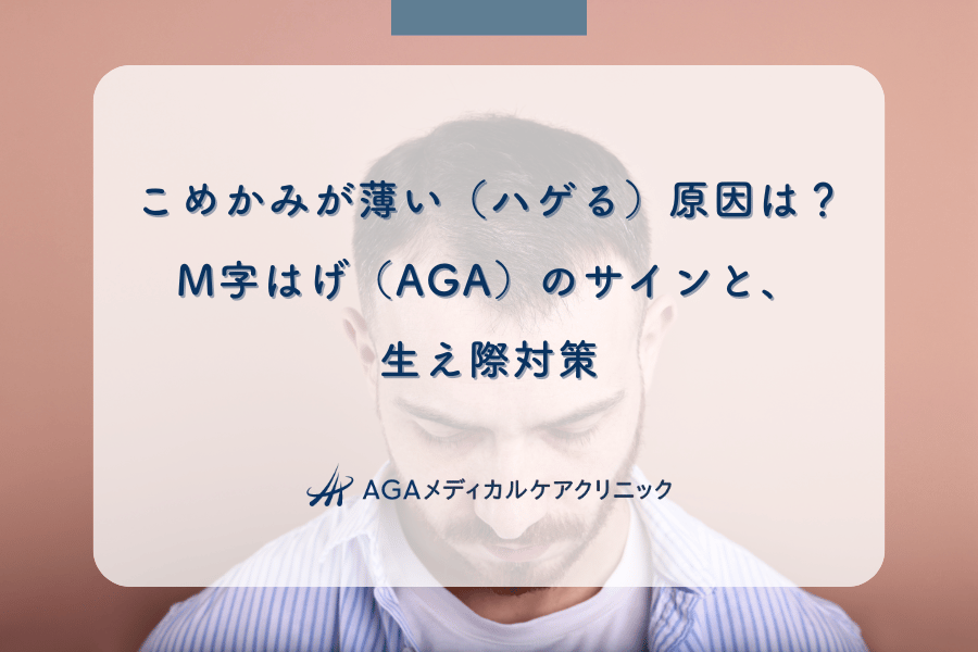 こめかみが薄い（ハゲる）原因は？M字はげ（AGA）のサインと、生え際対策