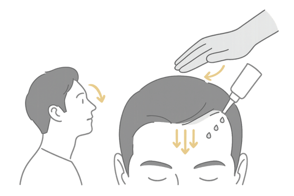 生え際への塗りミノキシジルの正しい塗布テクニック図｜点在塗布と馴染ませ方