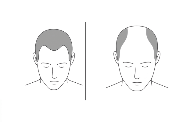 O字・M字・U字の進行パターン比較｜てっぺんはげの広がり方を3タイプで可視化