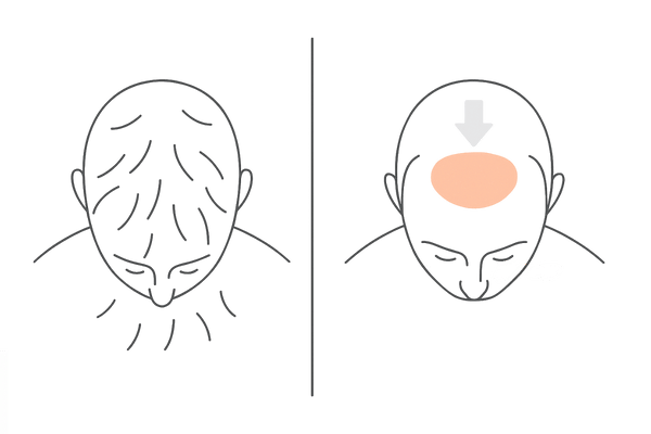 季節性の抜け毛とAGAの進行部位の違い
