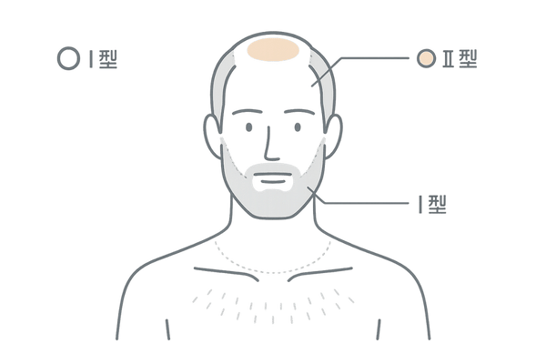 5αリダクターゼI型II型とAGA・体毛の関係を分布で示すイラスト