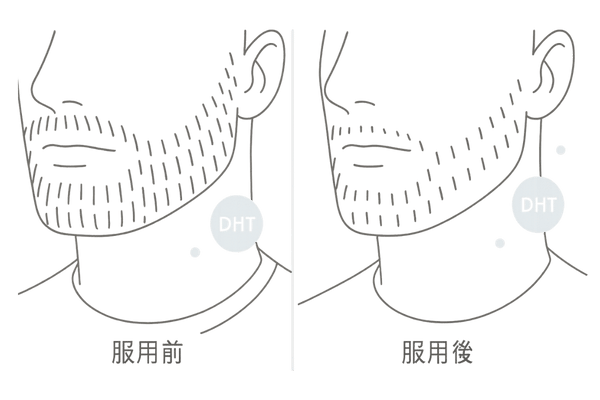 フィナステリド服用時の髭の濃さの変化イメージ