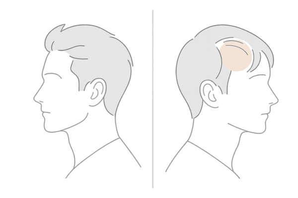 髪が細くなった男性のボリューム低下と地肌の透け感イラスト