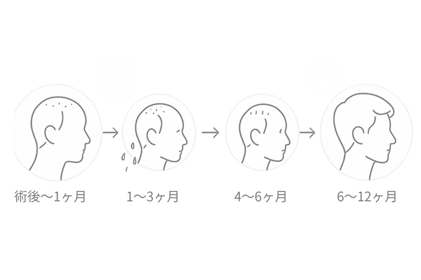 植毛後1年間の髪の伸び方タイムライン図
