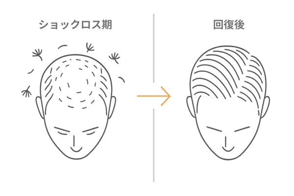 植毛後ショックロスとその後の回復イメージ図