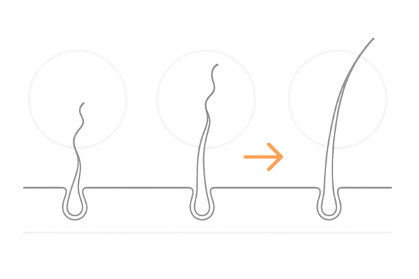 移植毛の髪質変化（細い産毛から太い毛へ成長する過程）図