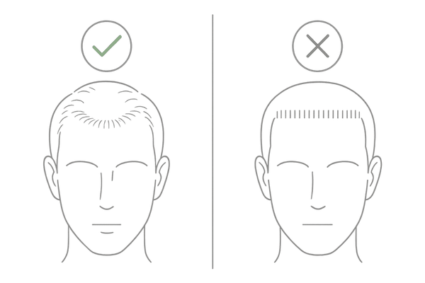 自然なヘアラインデザインと不自然な生え際の比較図
