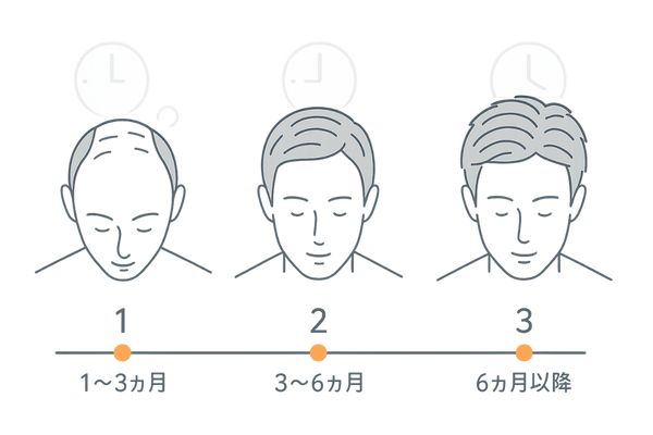 LED育毛治療の治療期間と発毛変化を示すタイムラインイラスト