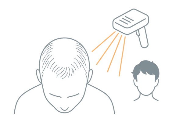 低出力レーザー照射によるAGA育毛治療のイメージ図