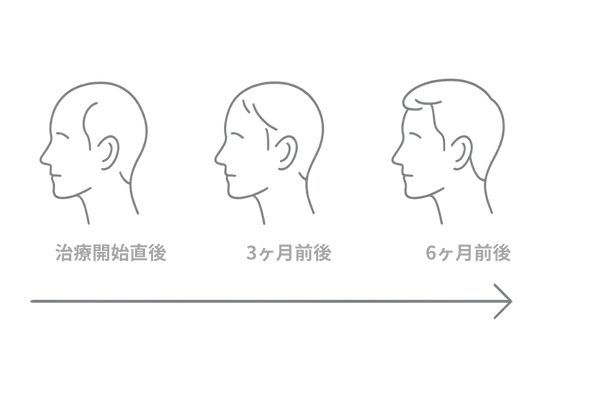 低出力レーザー育毛効果が現れるまでの3〜6ヶ月の期間イメージ