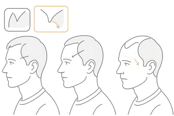 M字はげの進行度とハミルトン・ノーウッド分類イメージ図